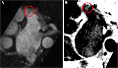 Use of a new non-contrast-enhanced BOOST cardiac MR sequence before electrical cardioversion or ablation of atrial fibrillation—a pilot study